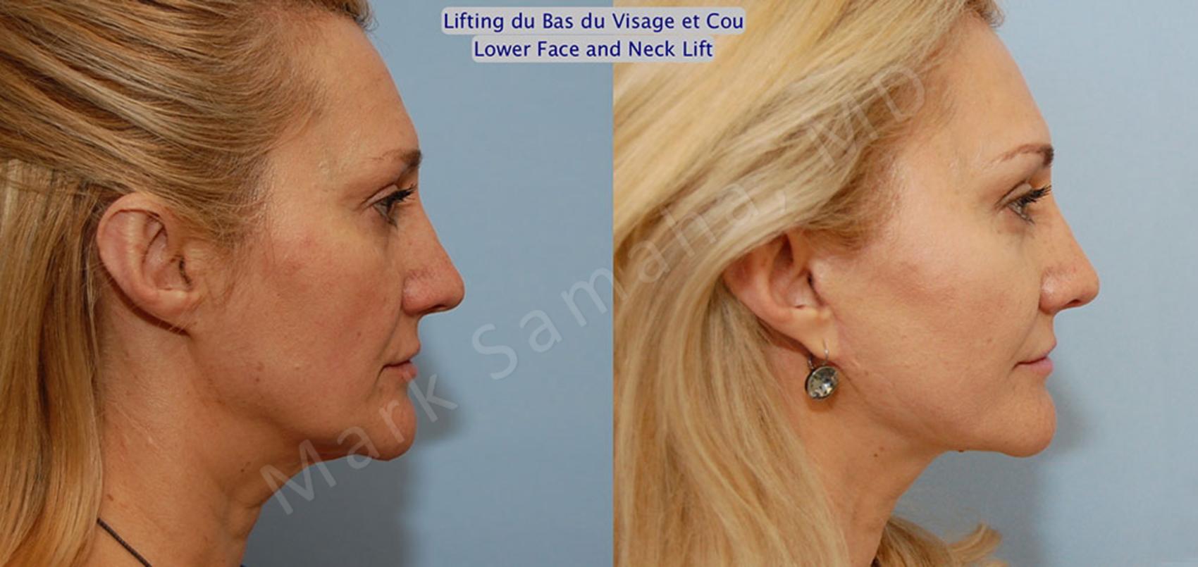 Before & After Lifting du visage / Cou - Facelift / Necklift Case 20 View #5 View in Montreal, QC