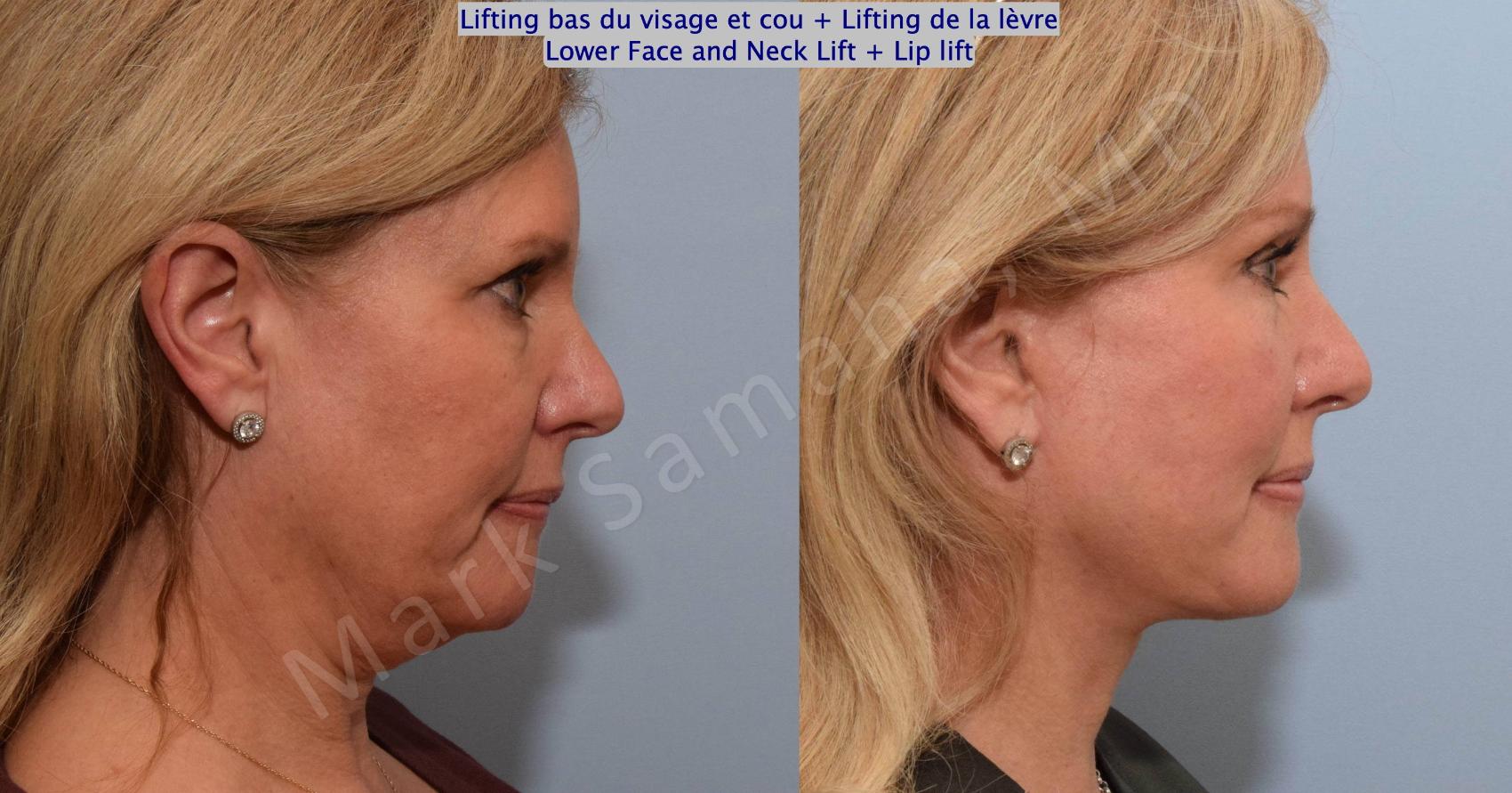 Before & After Lifting du visage / Cou - Facelift / Necklift Case 202 Right Side View in Montreal, QC