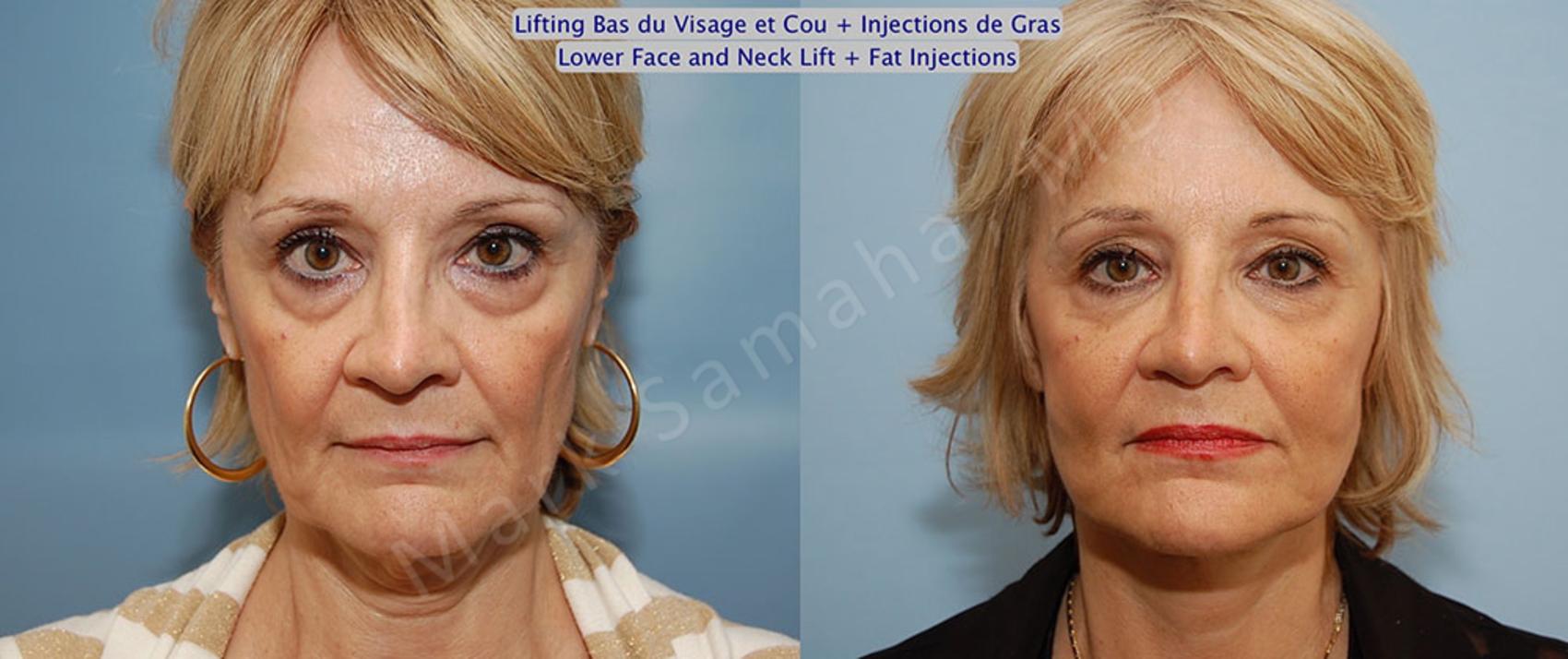 Before & After Lifting du visage / Cou - Facelift / Necklift Case 22 View #1 View in Montreal, QC
