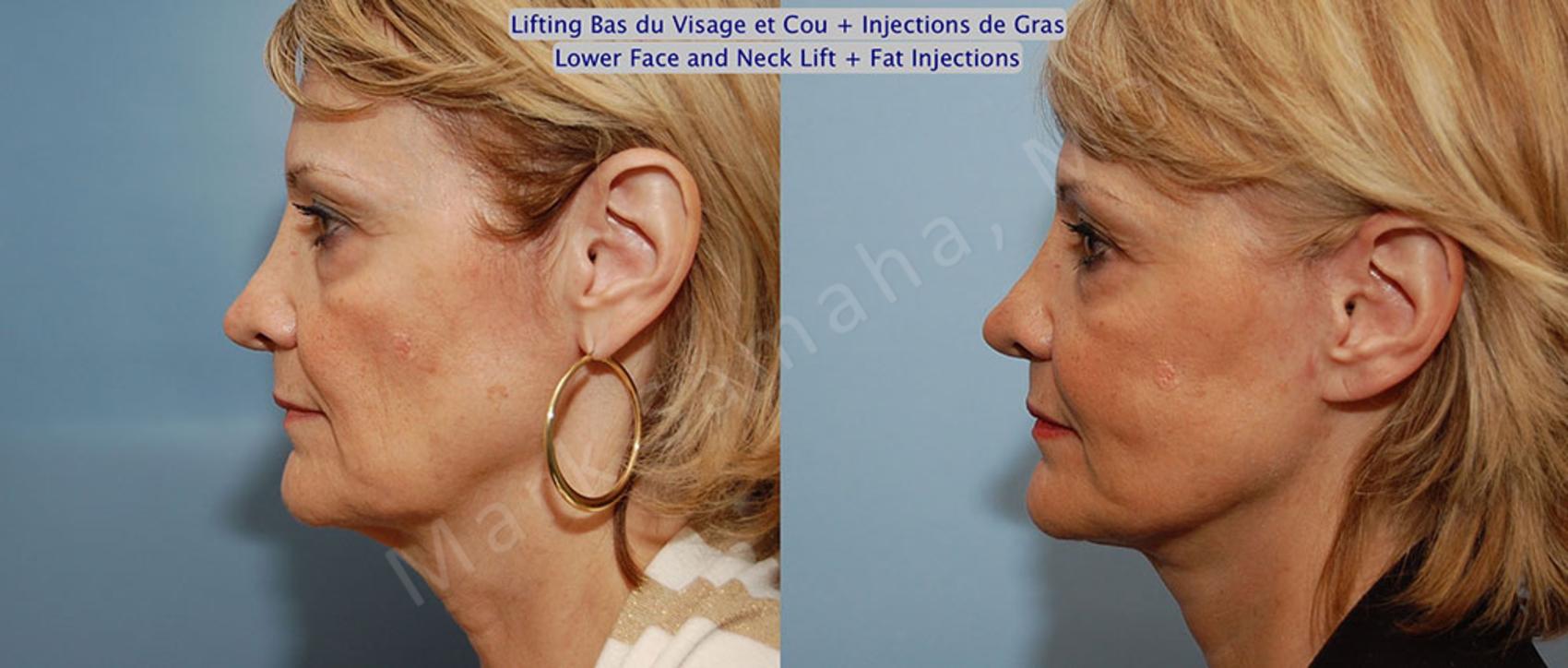 Before & After Lifting du visage / Cou - Facelift / Necklift Case 22 View #2 View in Montreal, QC