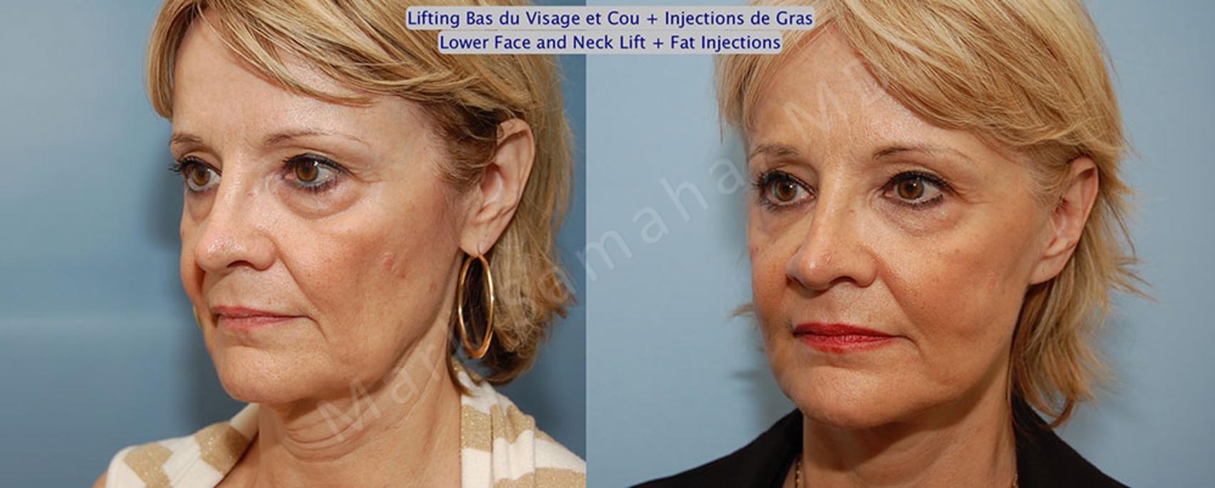 Before & After Lifting du visage / Cou - Facelift / Necklift Case 22 View #3 View in Montreal, QC