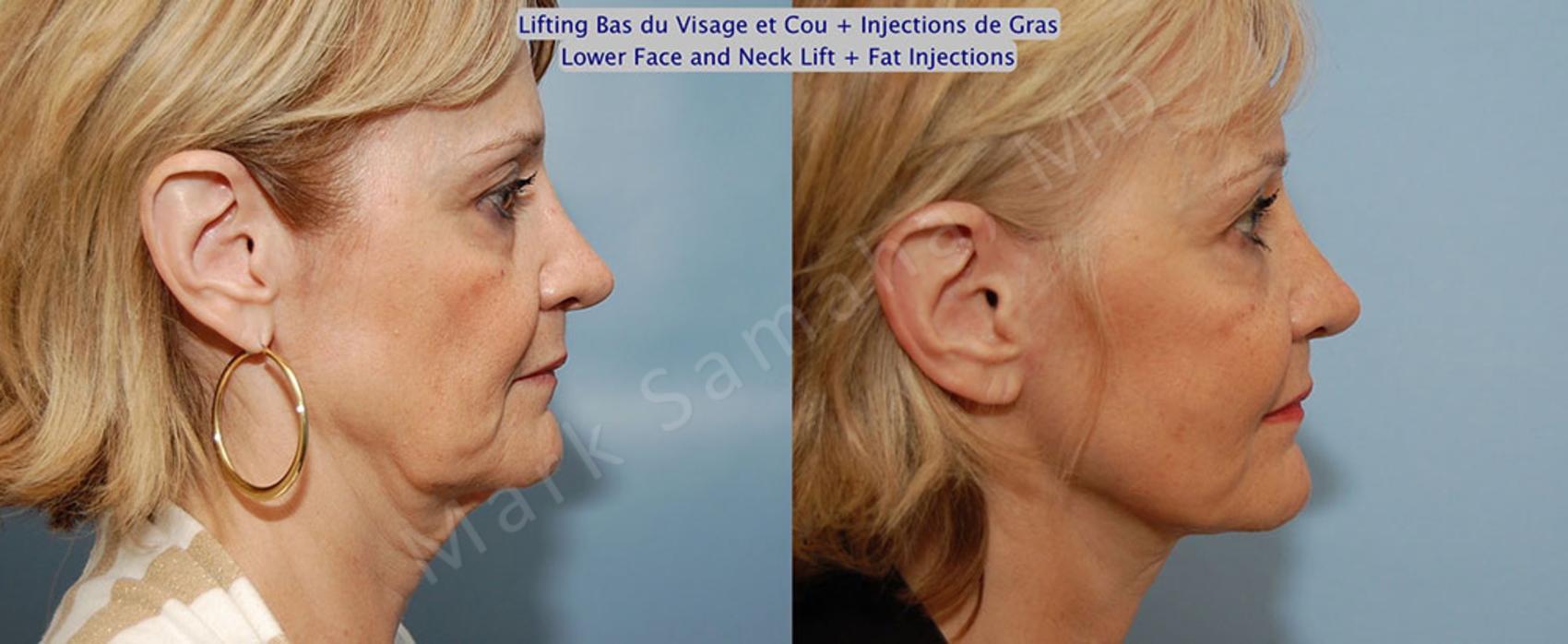 Before & After Lifting du visage / Cou - Facelift / Necklift Case 22 View #5 View in Montreal, QC