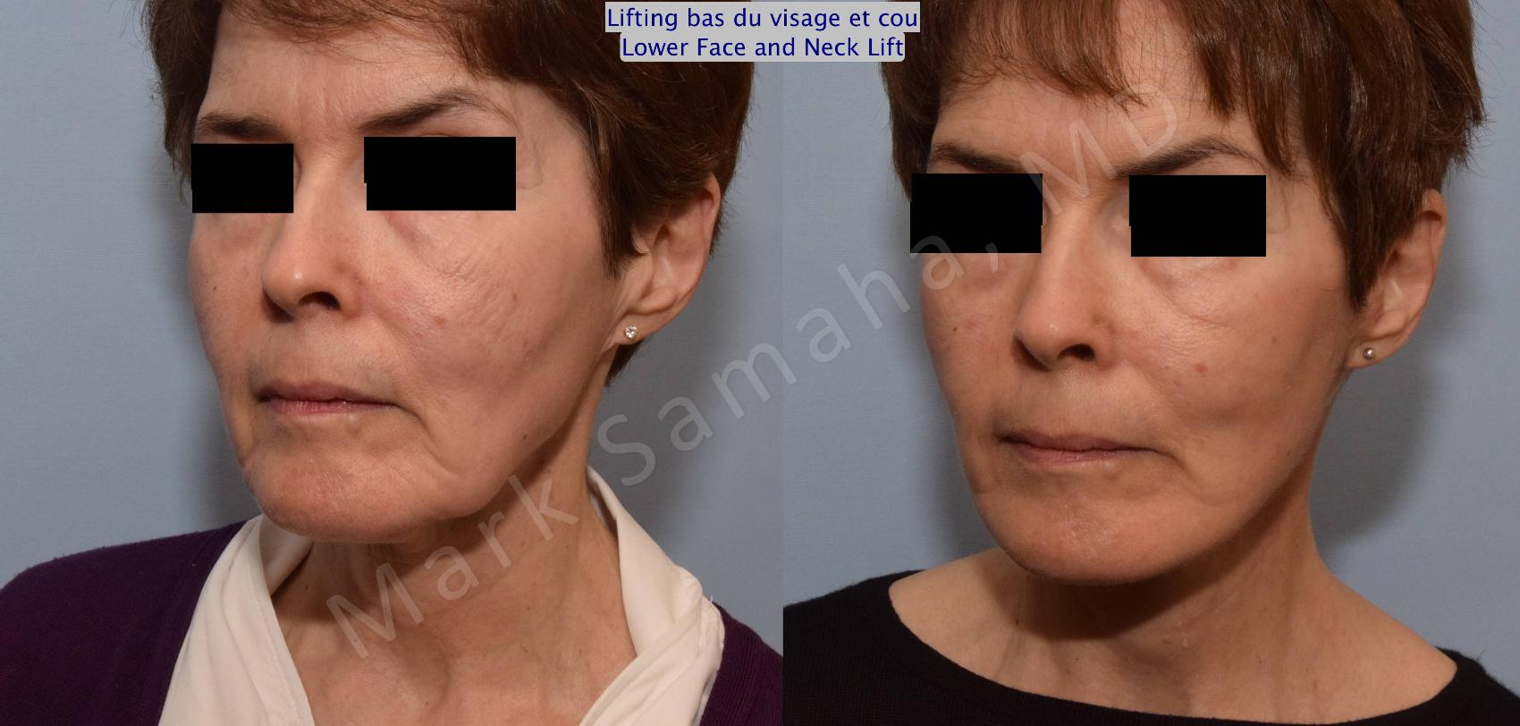 Before & After Lifting du visage / Cou - Facelift / Necklift Case 66 View #4 View in Montreal, QC