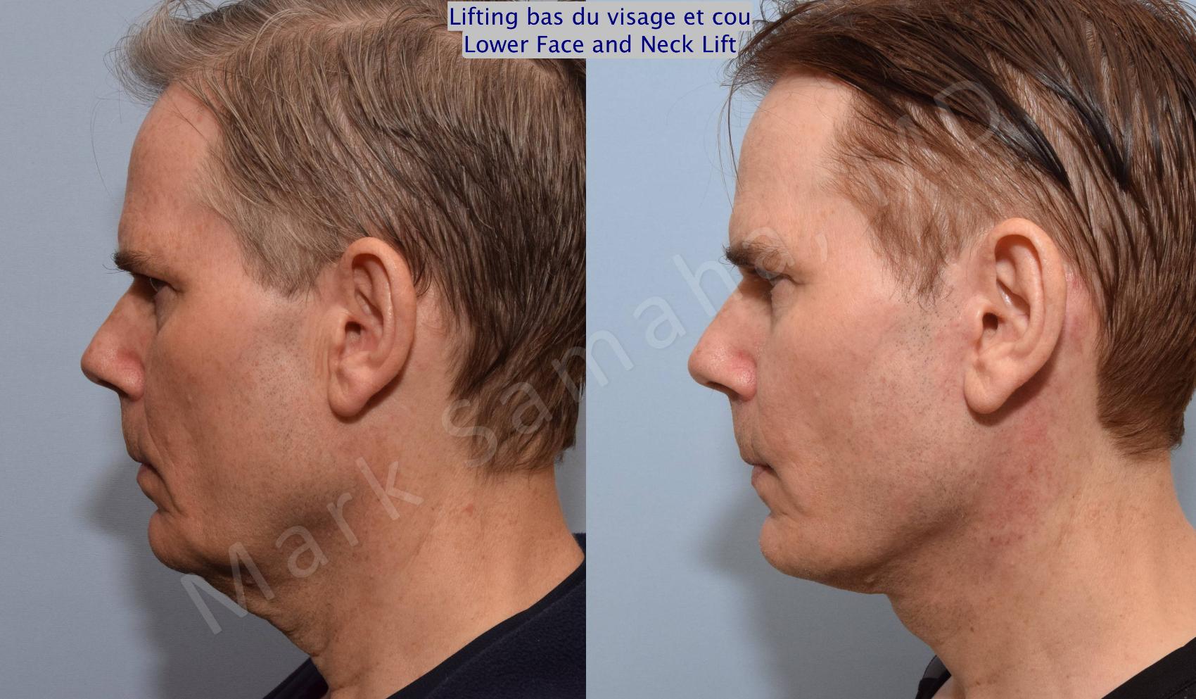 Before & After Lifting du visage / Cou - Facelift / Necklift Case 67 View #2 View in Montreal, QC