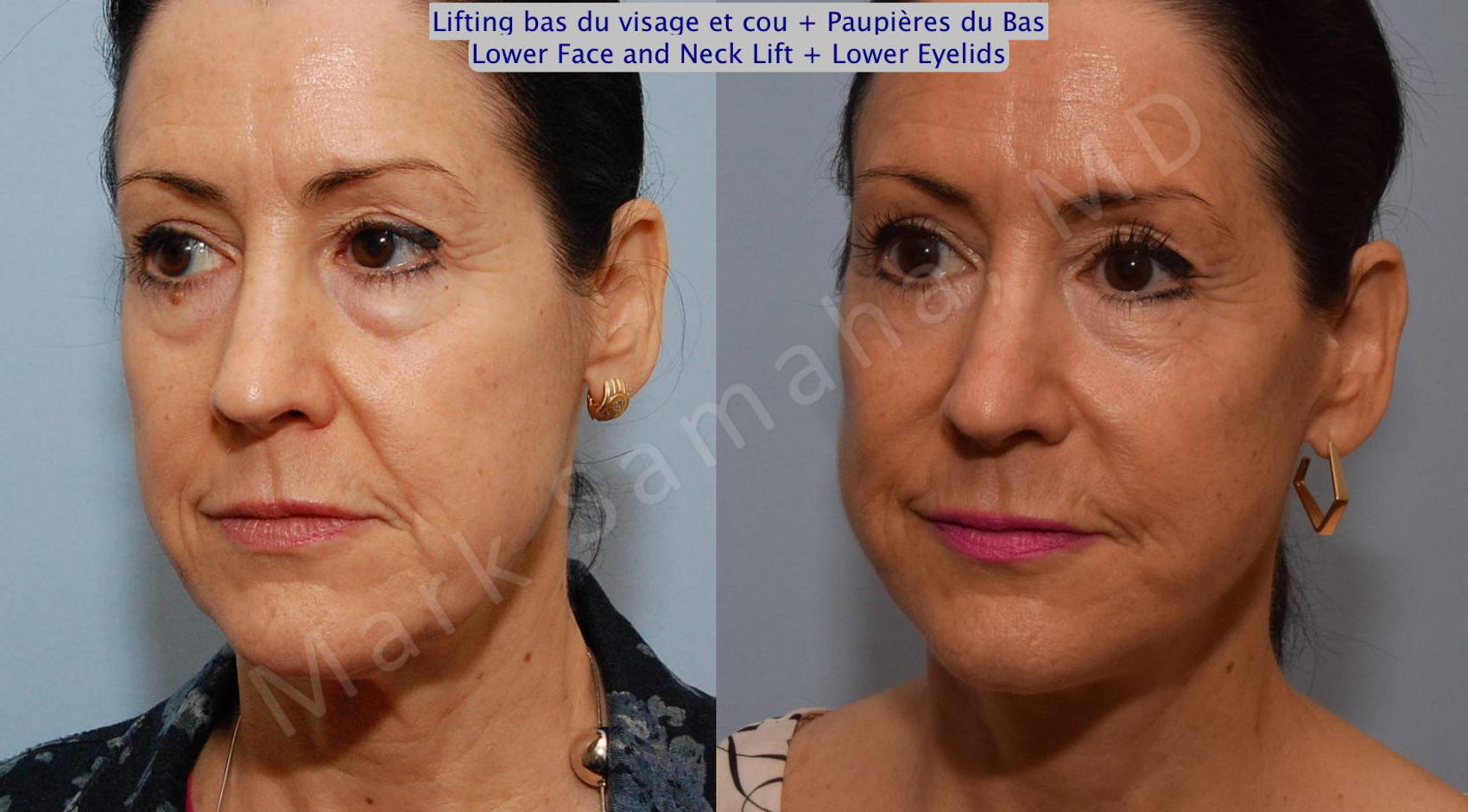 Before & After Lifting du visage / Cou - Facelift / Necklift Case 69 View #5 View in Montreal, QC