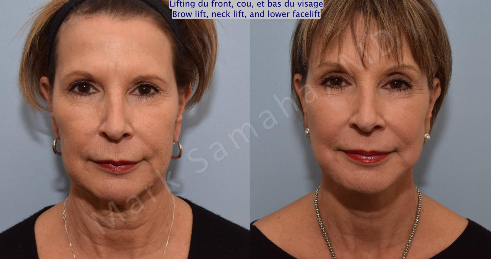 Before & After Lifting du visage / Cou - Facelift / Necklift Case 92 View #1 View in Montreal, QC