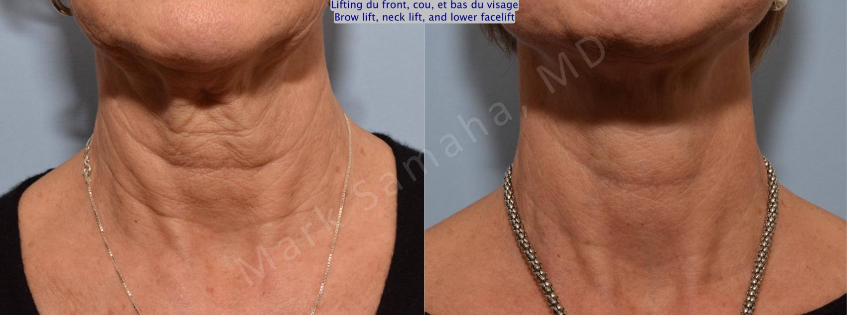 Before & After Lifting du visage / Cou - Facelift / Necklift Case 92 View #2 View in Montreal, QC