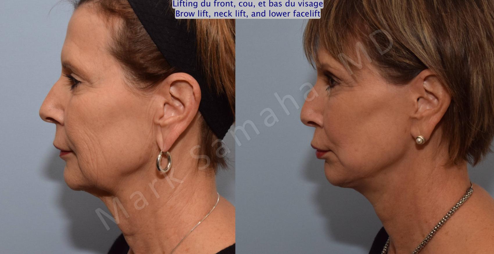 Before & After Lifting du visage / Cou - Facelift / Necklift Case 92 View #3 View in Montreal, QC