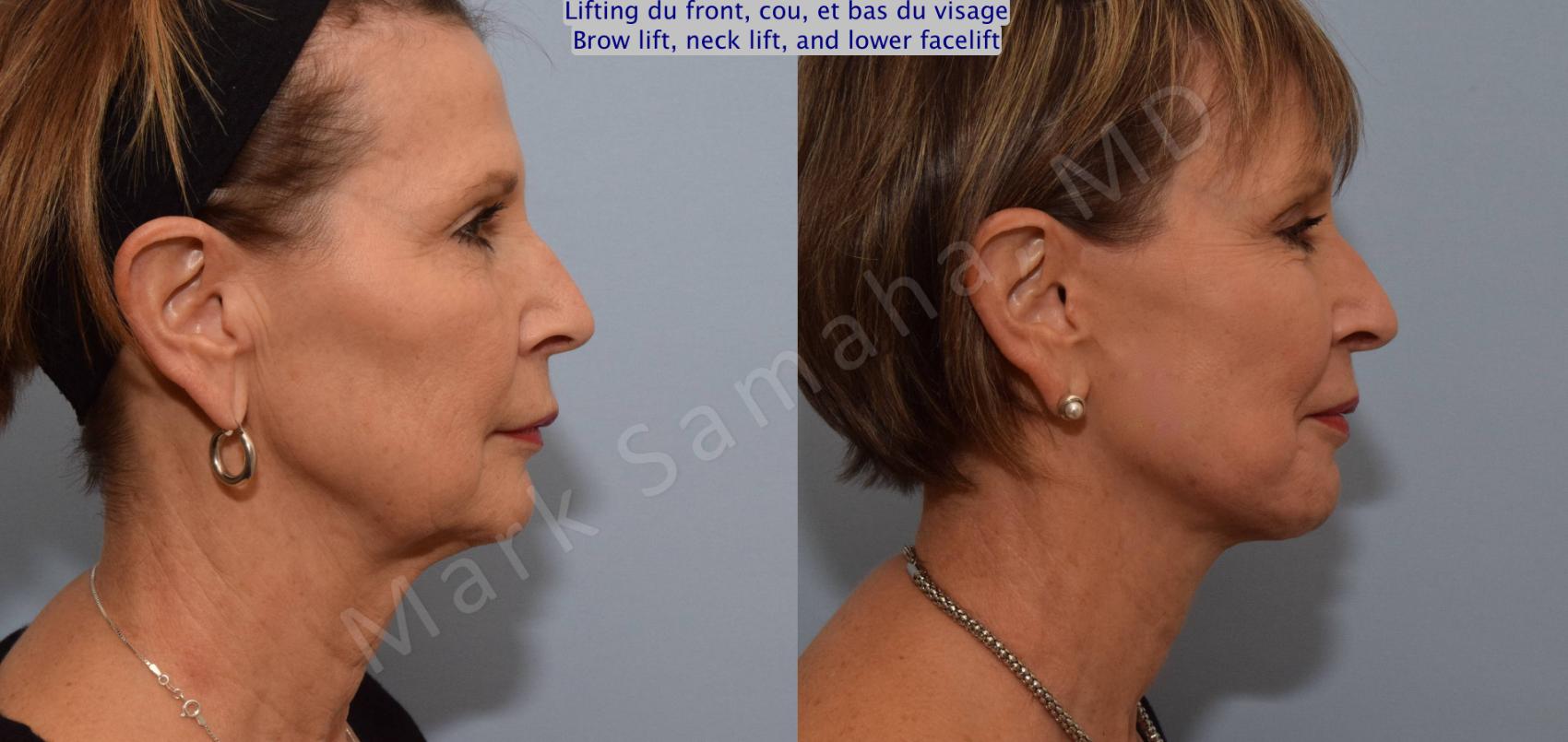 Before & After Lifting du visage / Cou - Facelift / Necklift Case 92 View #4 View in Montreal, QC