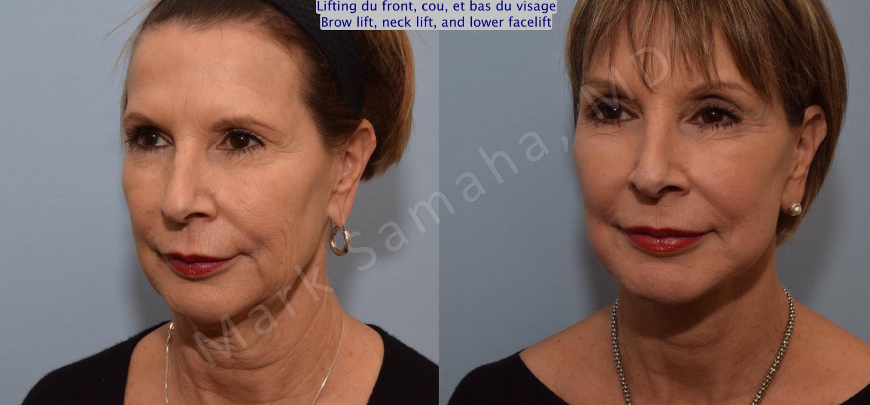 Before & After Lifting du visage / Cou - Facelift / Necklift Case 92 View #5 View in Montreal, QC
