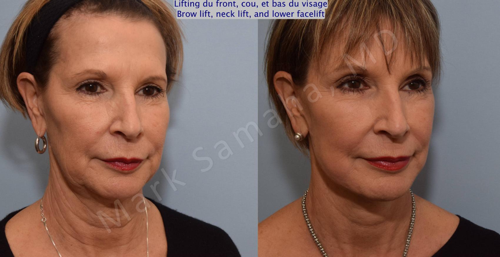 Before & After Lifting du visage / Cou - Facelift / Necklift Case 92 View #6 View in Montreal, QC