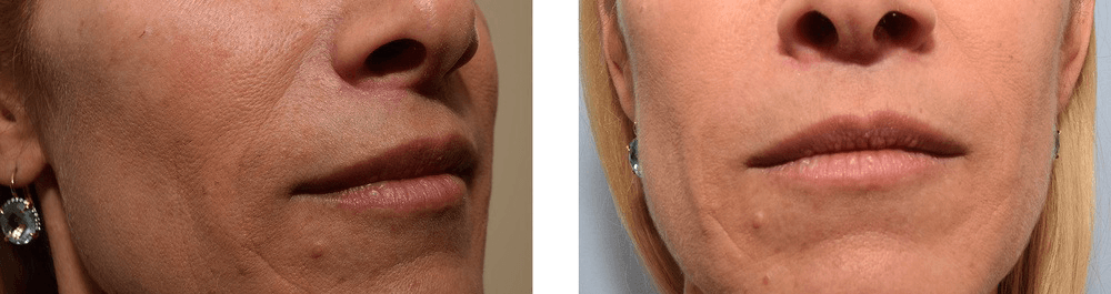 Patient with scar below lip