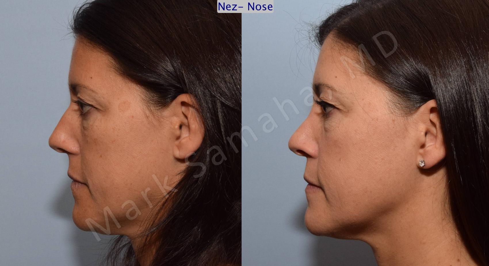 Before & After Rhinoplastie / Rhinoplasty Case 93 View #2 View in Montreal, QC