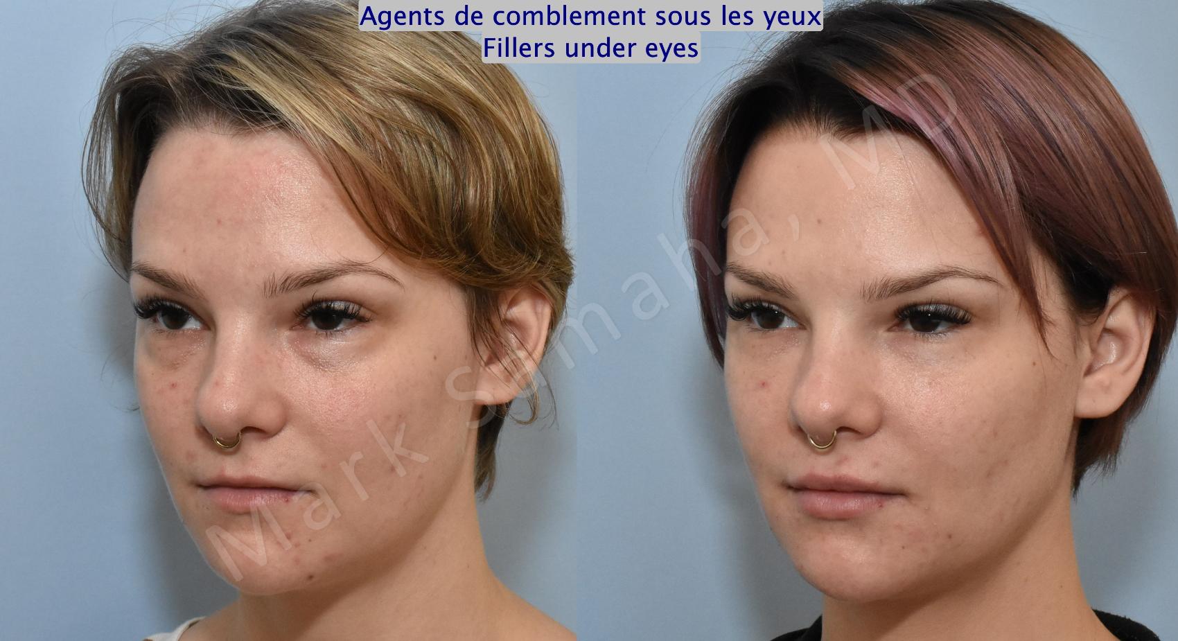 Before & After Agents de Comblement-Remplisseurs / Dermal Fillers Case 165 Left Oblique View in Montreal, QC