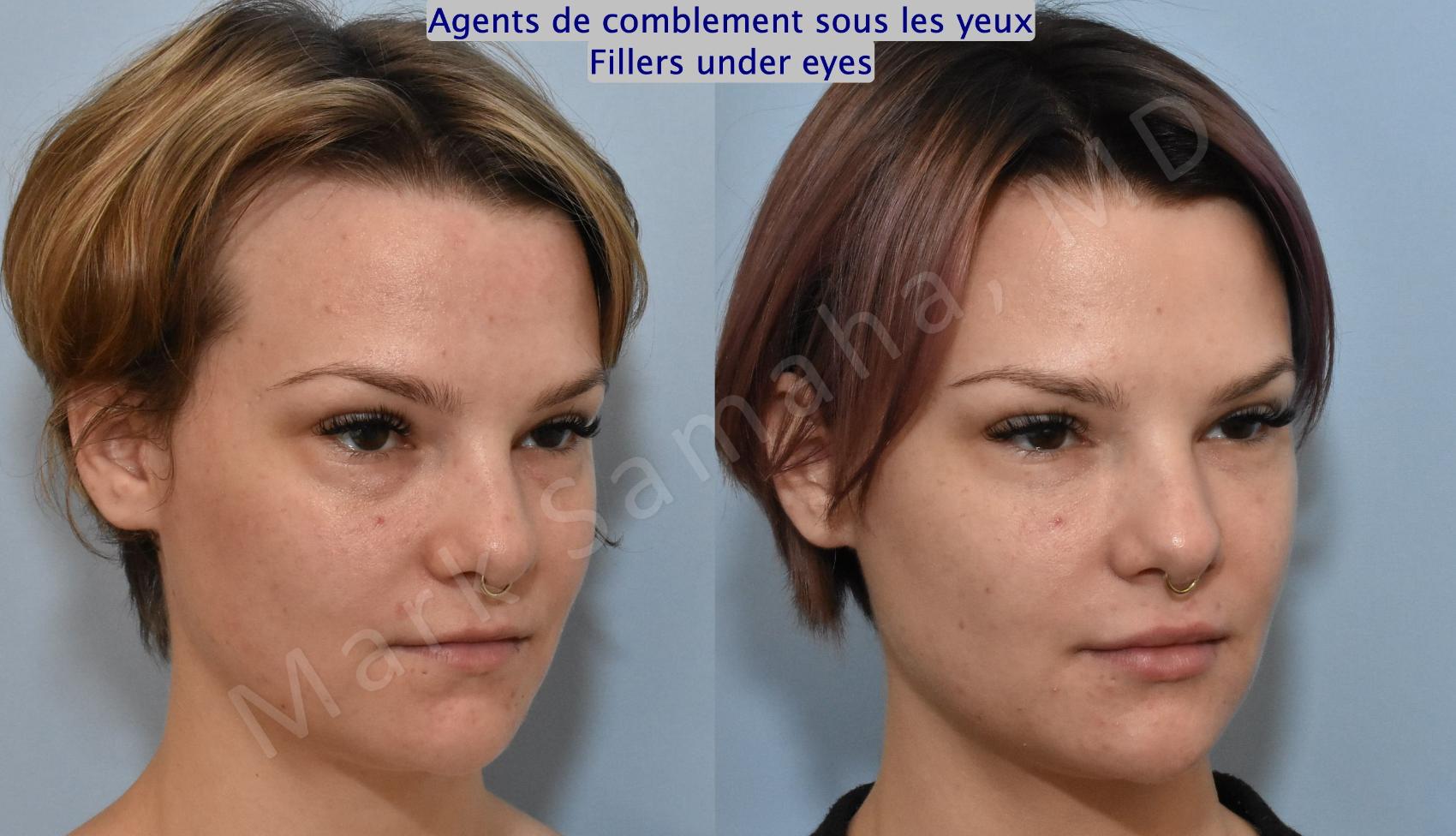 Before & After Agents de Comblement-Remplisseurs / Dermal Fillers Case 165 Right Oblique View in Montreal, QC