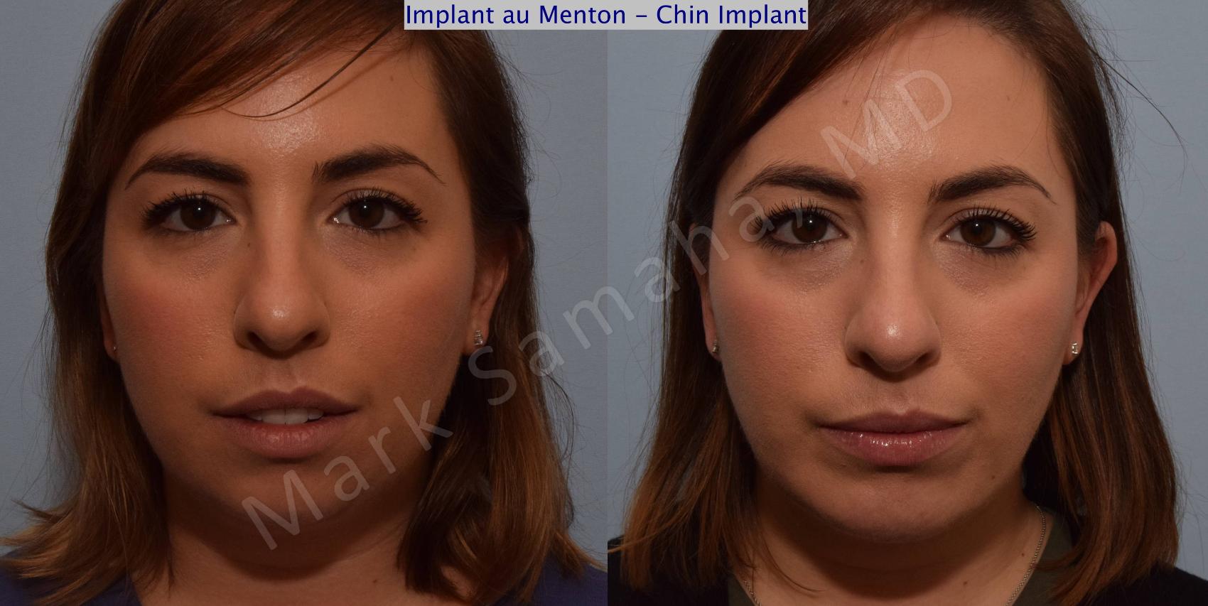 Before & After Augmentation du menton / Chin Augmentation Case 104 View #3 View in Montreal, QC