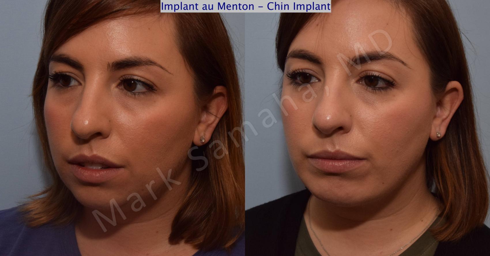 Before & After Augmentation du menton / Chin Augmentation Case 104 View #4 View in Montreal, QC
