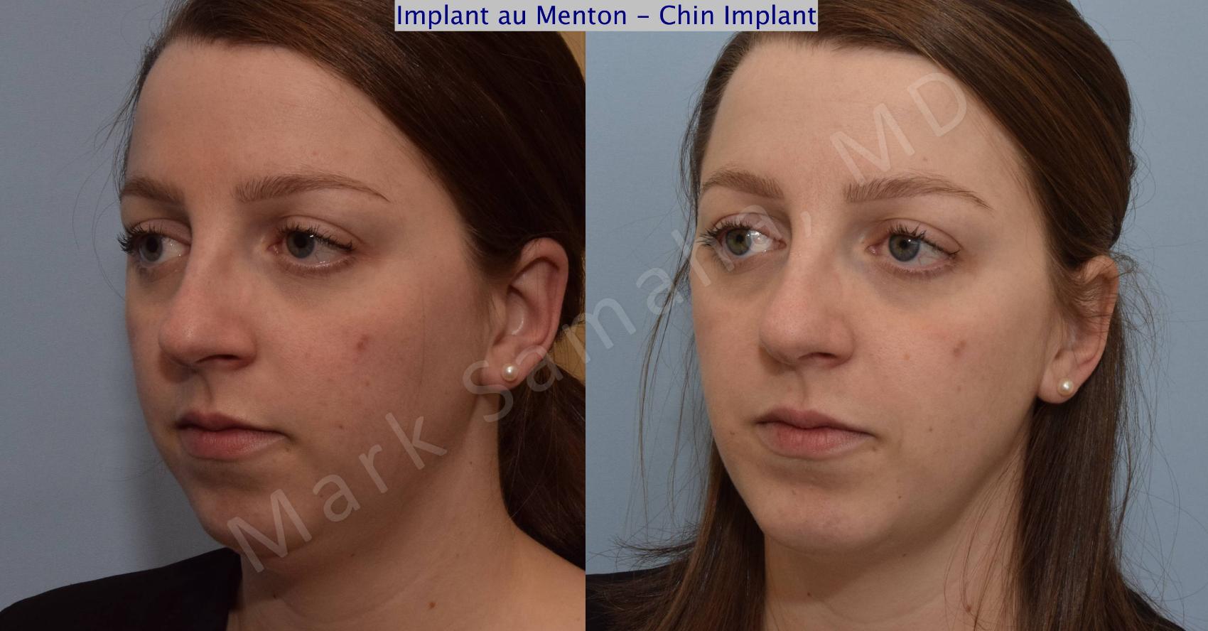 Before & After Augmentation du menton / Chin Augmentation Case 111 View #4 View in Montreal, QC