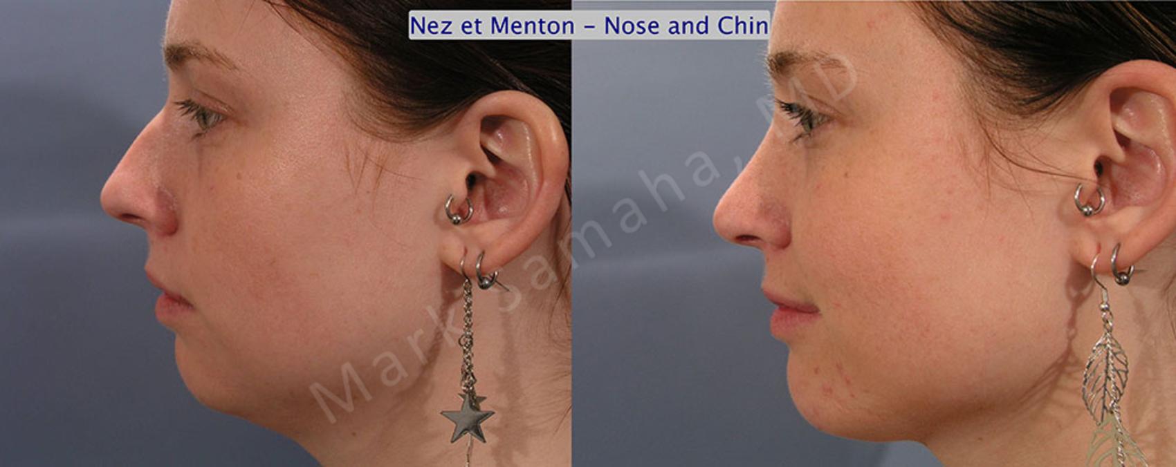 Before & After Augmentation du menton / Chin Augmentation Case 12 View #1 #Detail2 View in Montreal, QC