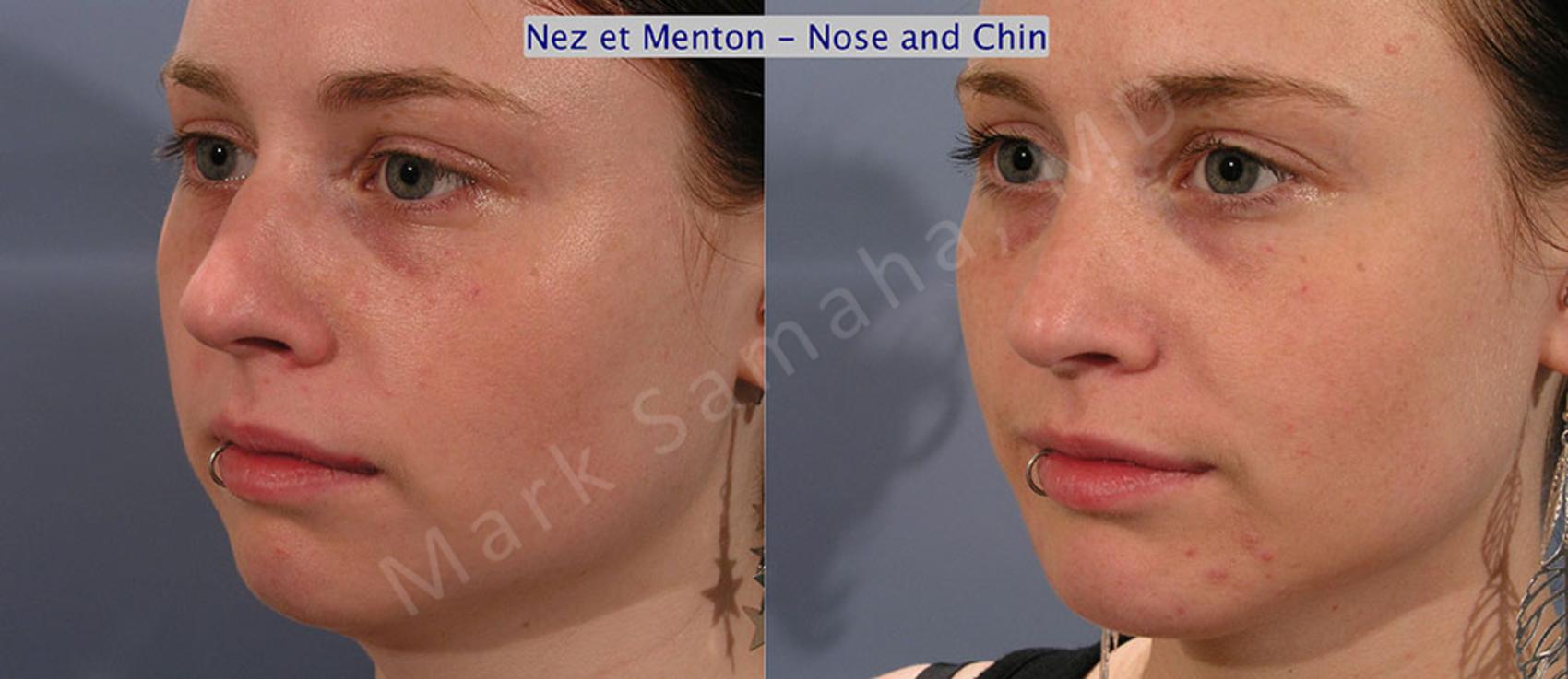 Before & After Augmentation du menton / Chin Augmentation Case 12 View #2 #Detail2 View in Montreal, QC