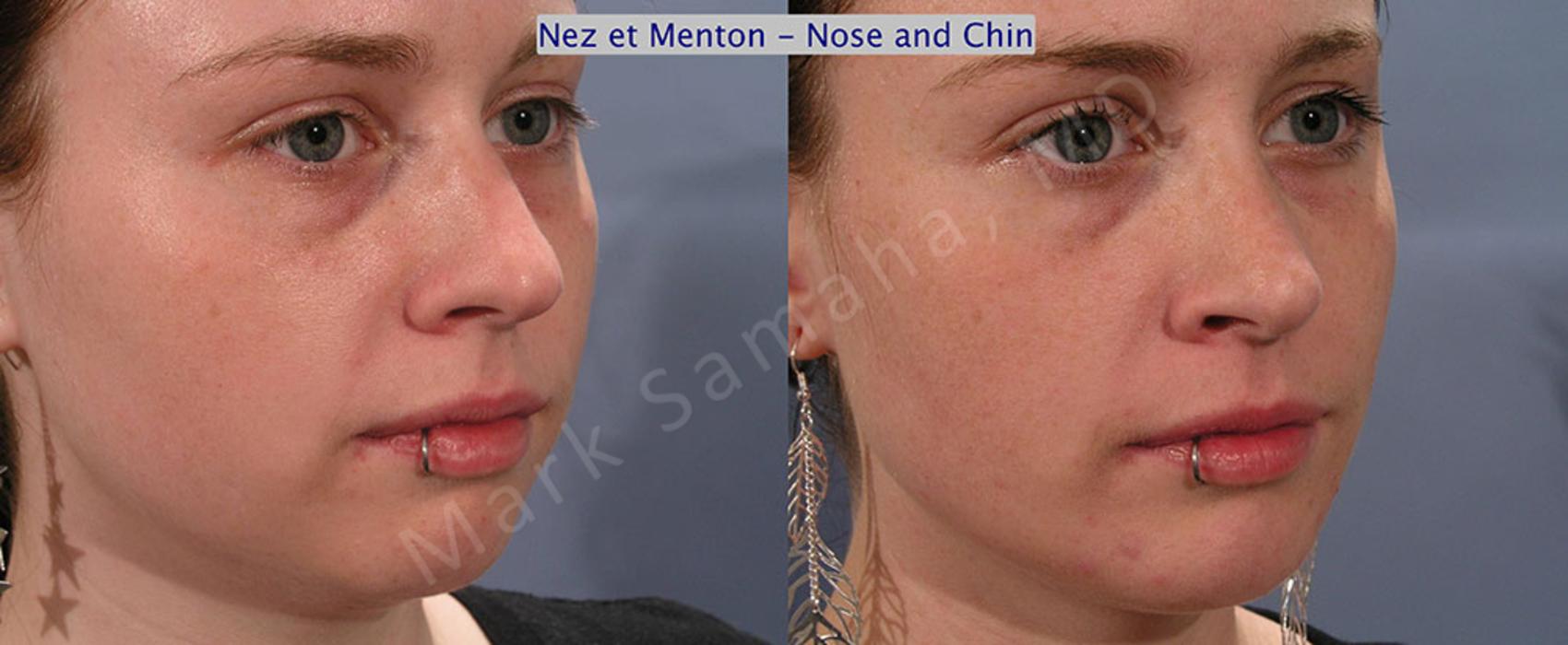 Before & After Augmentation du menton / Chin Augmentation Case 12 View #3 Detail View in Montreal, QC