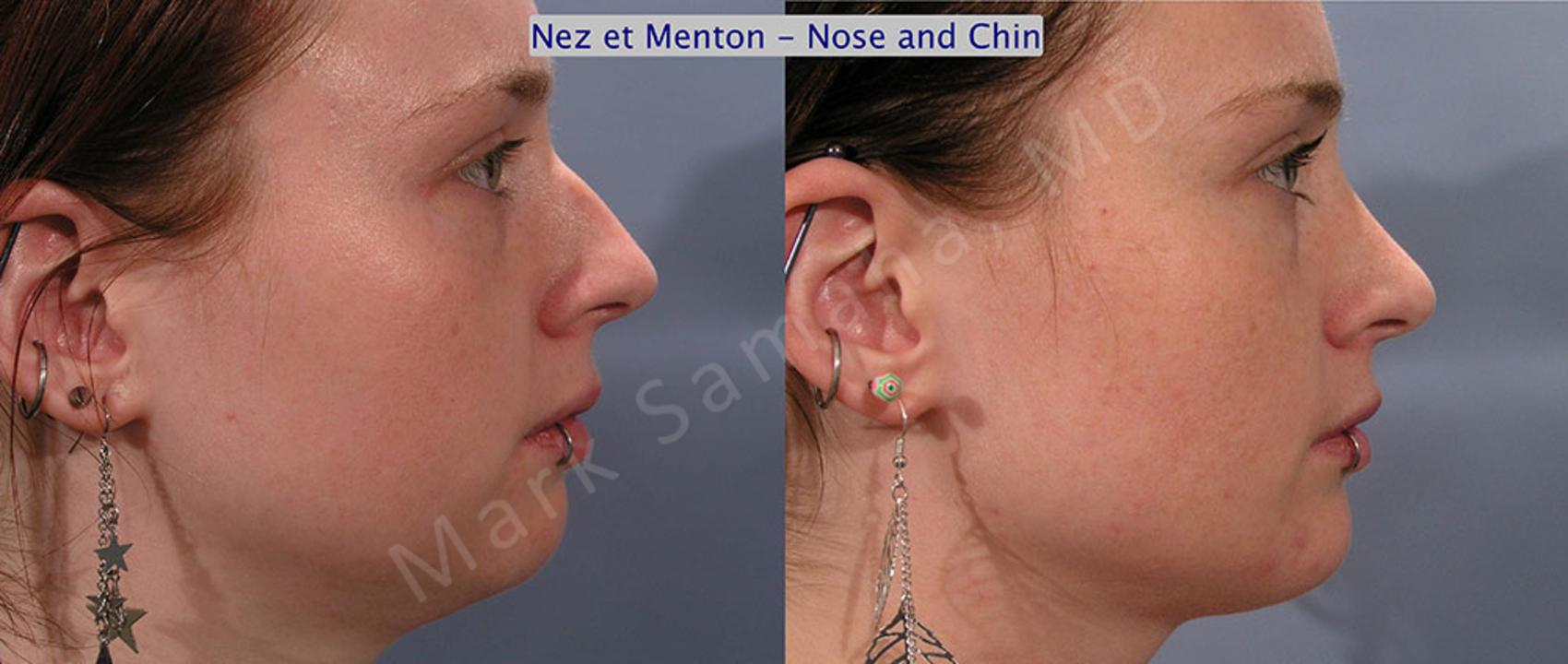 Before & After Augmentation du menton / Chin Augmentation Case 12 View #4 #Detail2 View in Montreal, QC