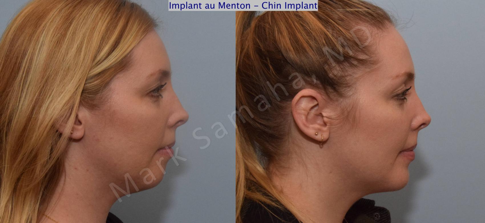 Before & After Augmentation du menton / Chin Augmentation Case 120 View #2 View in Montreal, QC