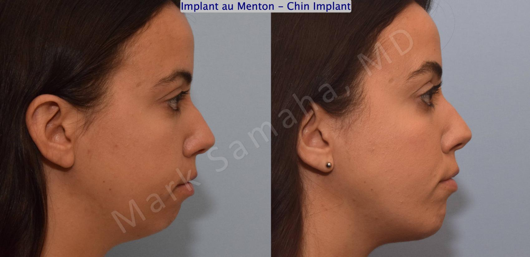 Before & After Augmentation du menton / Chin Augmentation Case 121 View #3 View in Montreal, QC