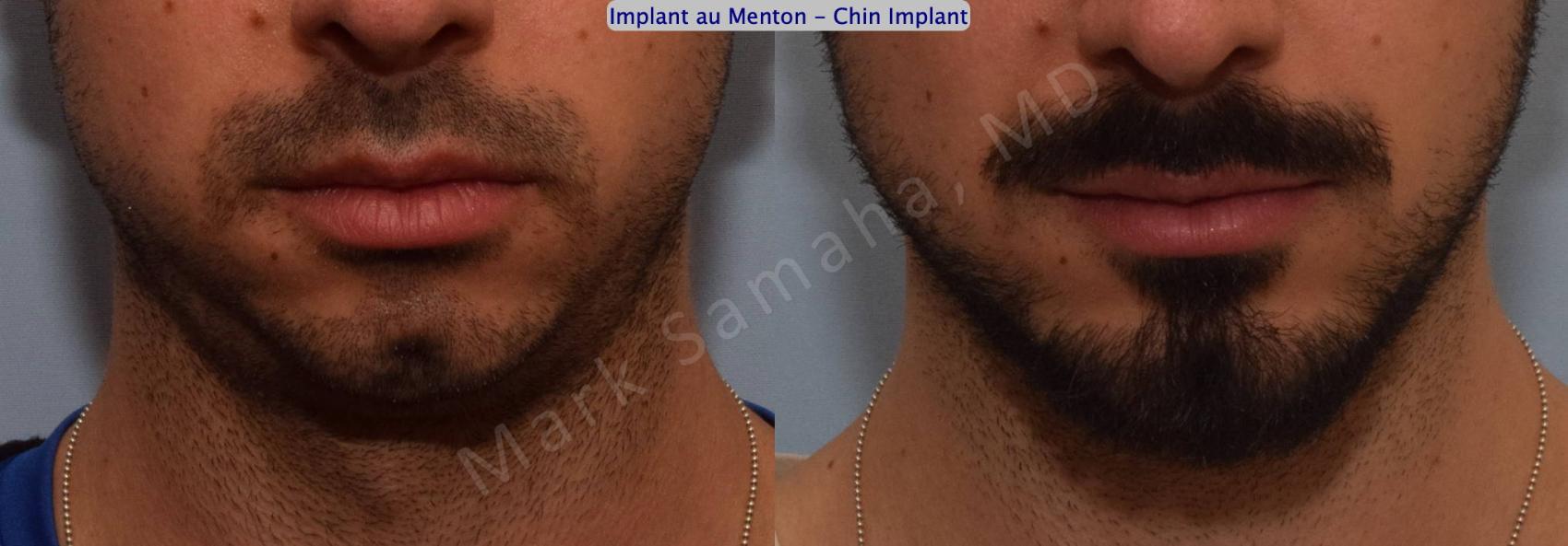 Before & After Augmentation du menton / Chin Augmentation Case 126 View #2 View in Montreal, QC