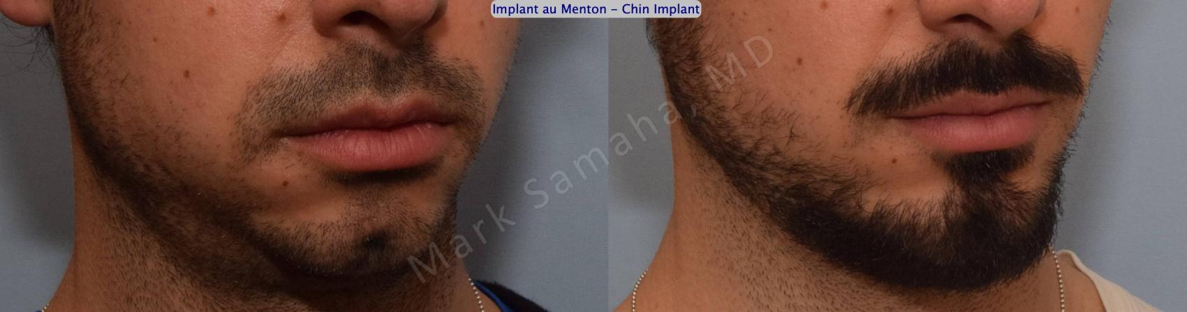 Before & After Augmentation du menton / Chin Augmentation Case 126 View #5 View in Montreal, QC