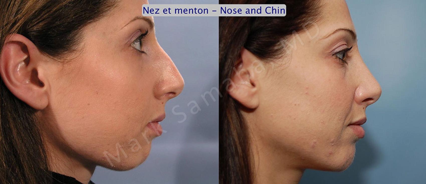 Before & After Augmentation du menton / Chin Augmentation Case 13 View #1 #Detail2 View in Montreal, QC