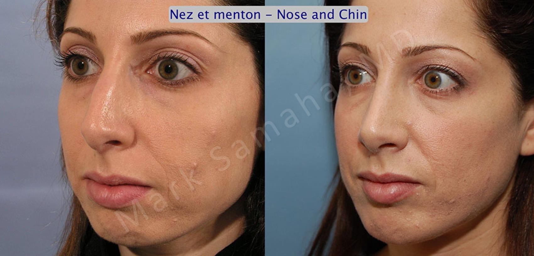 Before & After Augmentation du menton / Chin Augmentation Case 13 View #2 #Detail2 View in Montreal, QC