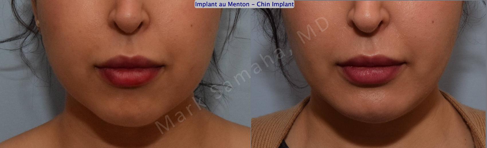 Before & After Augmentation du menton / Chin Augmentation Case 133 View #2 View in Montreal, QC