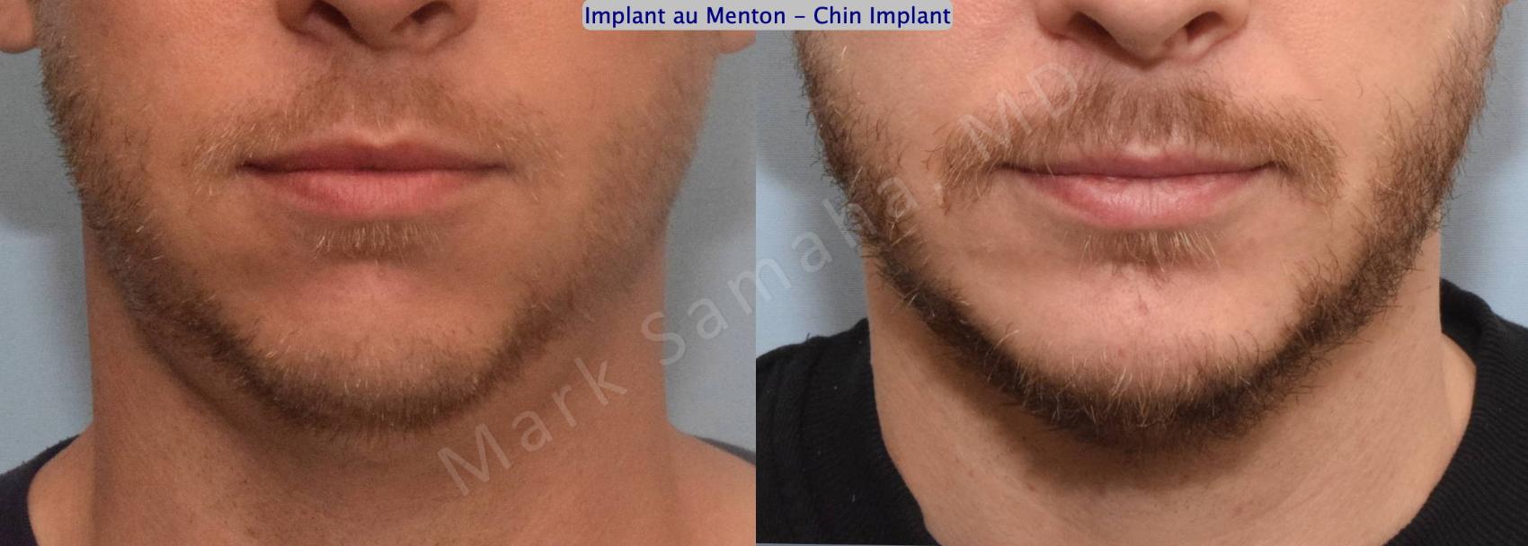 Before & After Augmentation du menton / Chin Augmentation Case 135 View #2 View in Montreal, QC