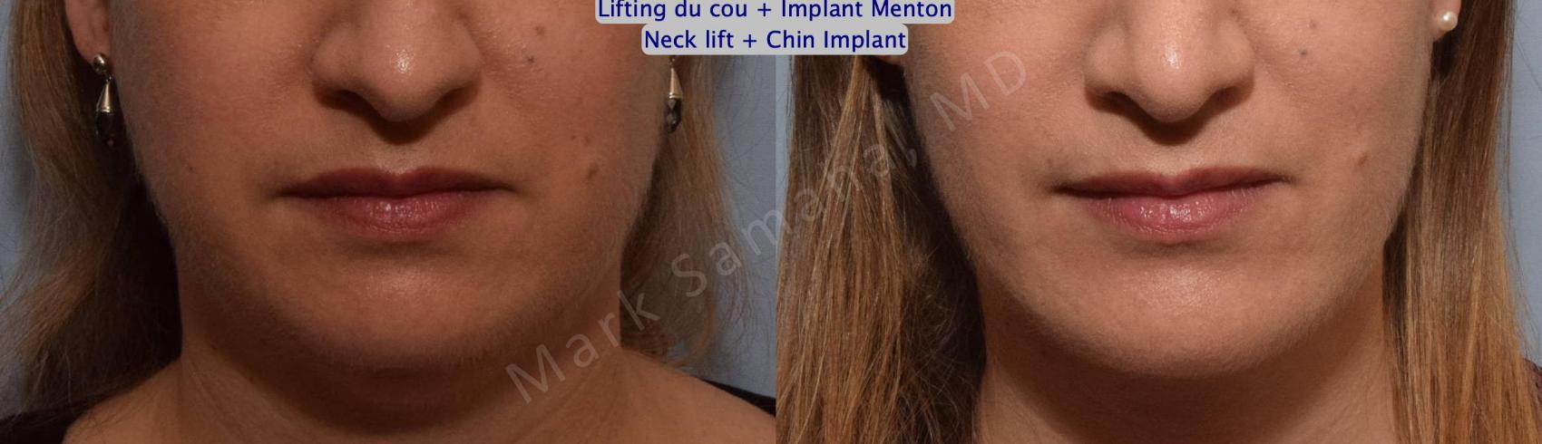 Before & After Augmentation du menton / Chin Augmentation Case 147 Front View in Montreal, QC