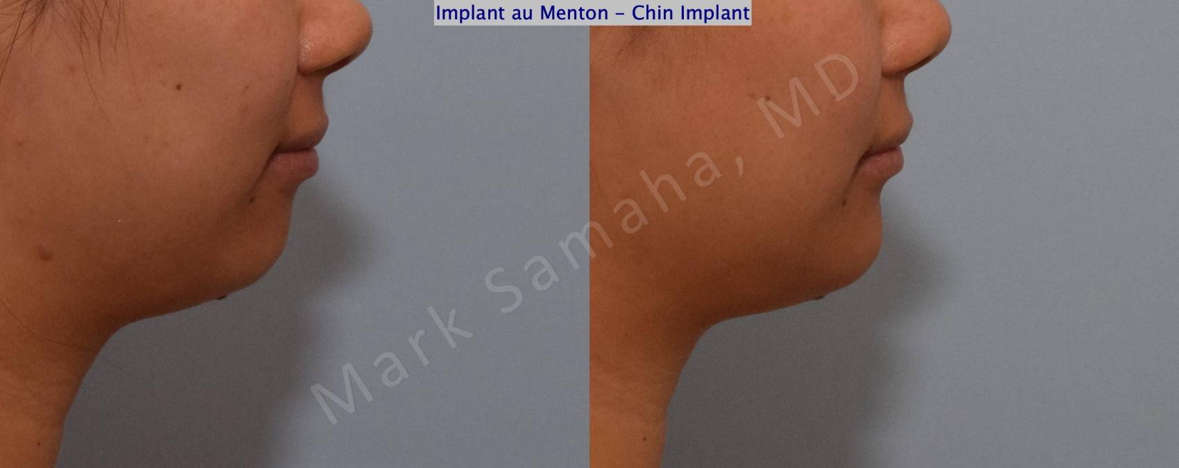 Before & After Augmentation du menton / Chin Augmentation Case 148 Right Side View in Montreal, QC