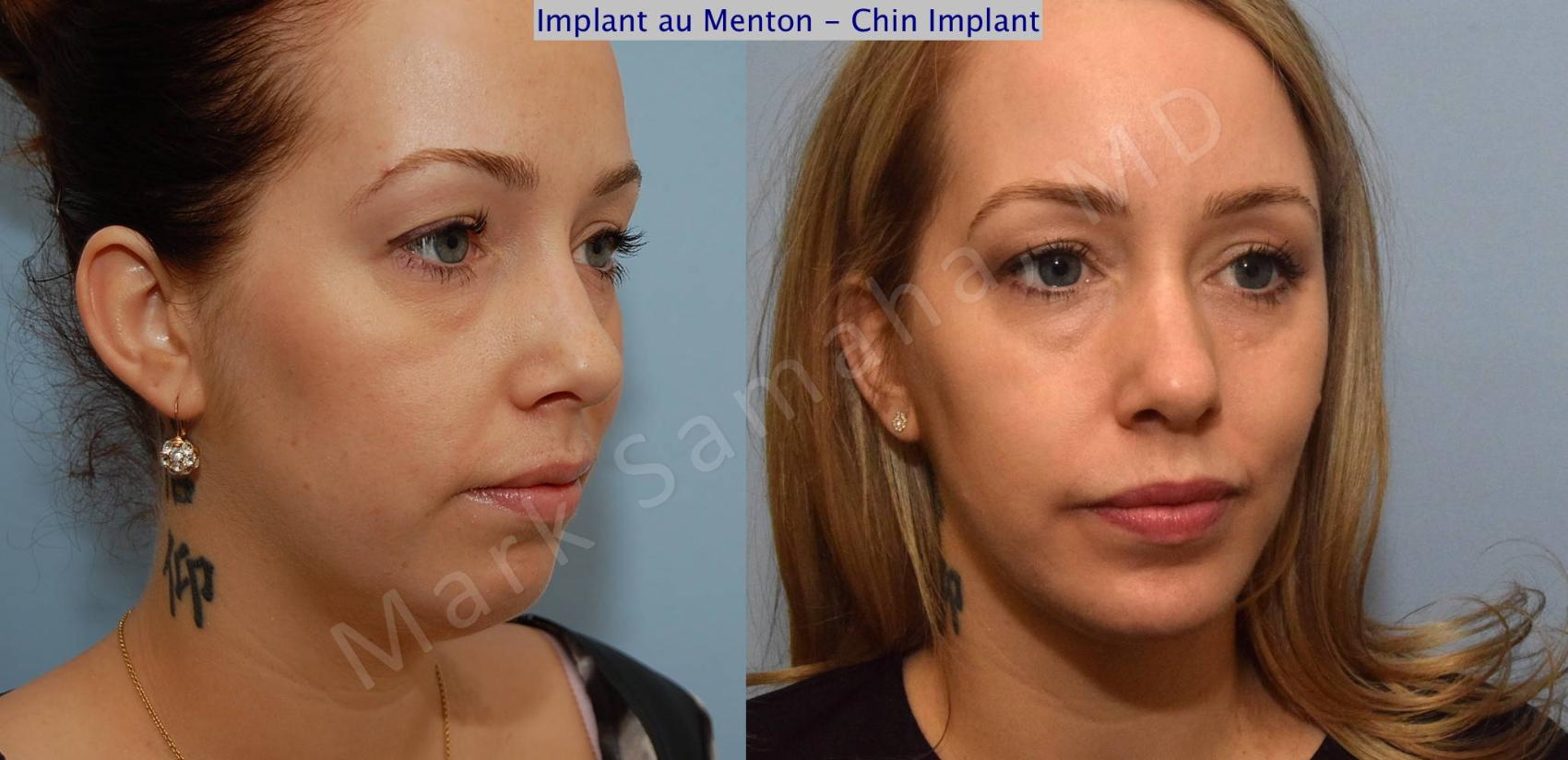 Before & After Augmentation du menton / Chin Augmentation Case 99 View #5 View in Montreal, QC