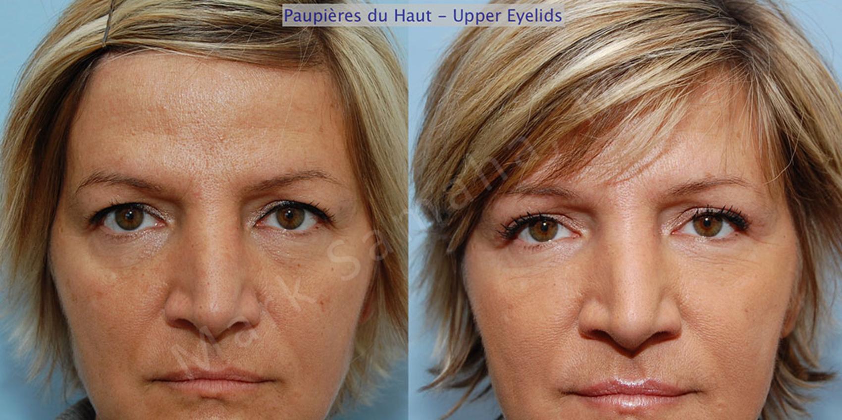 Before & After Blépharoplastie / Blepharoplasty Case 1  View in Montreal, QC
