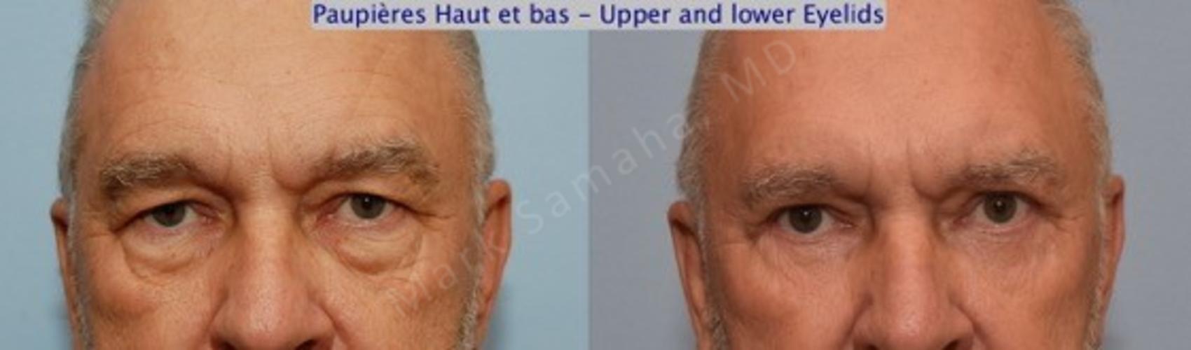 Before & After Blépharoplastie / Blepharoplasty Case 62 View #1 #Detail2 View in Montreal, QC