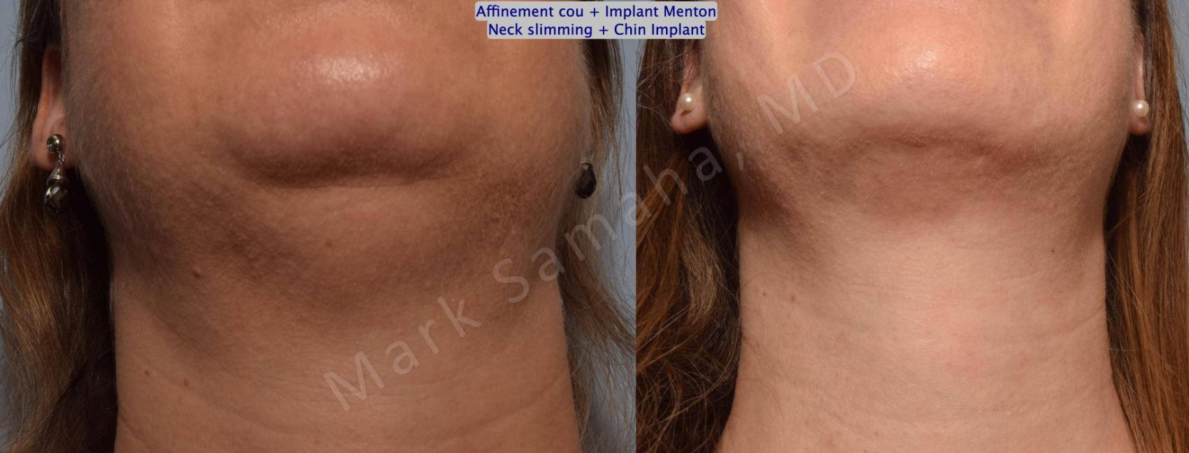 Before & After Chirurgie d’affinement du visage / Face Slimming Surgery Case 161 Neck Cou View in Montreal, QC