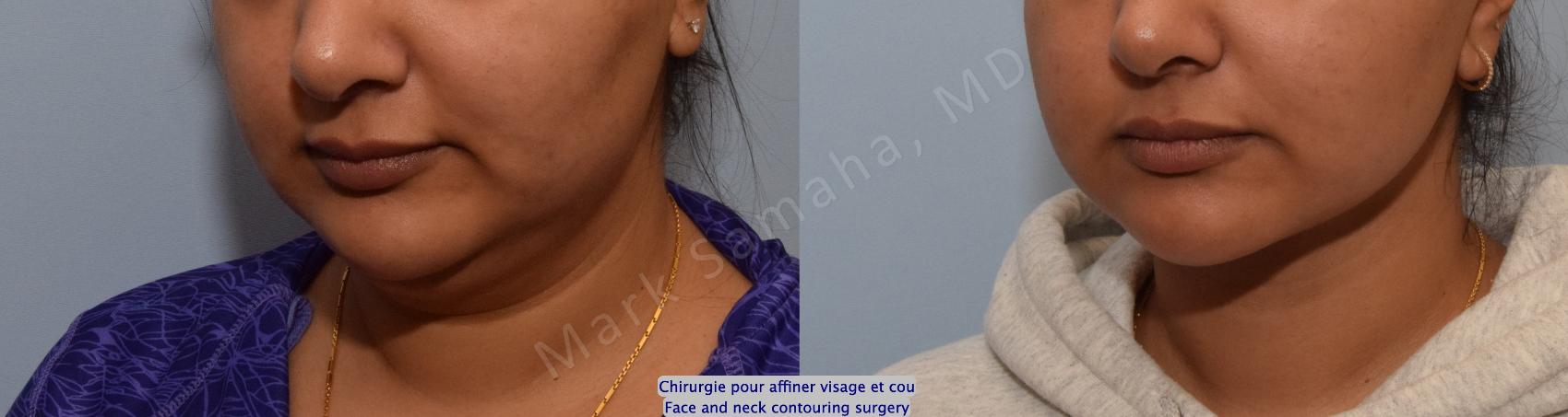 Before & After Chirurgie d’affinement du visage / Face Slimming Surgery Case 204 Left Oblique View in Montreal, QC