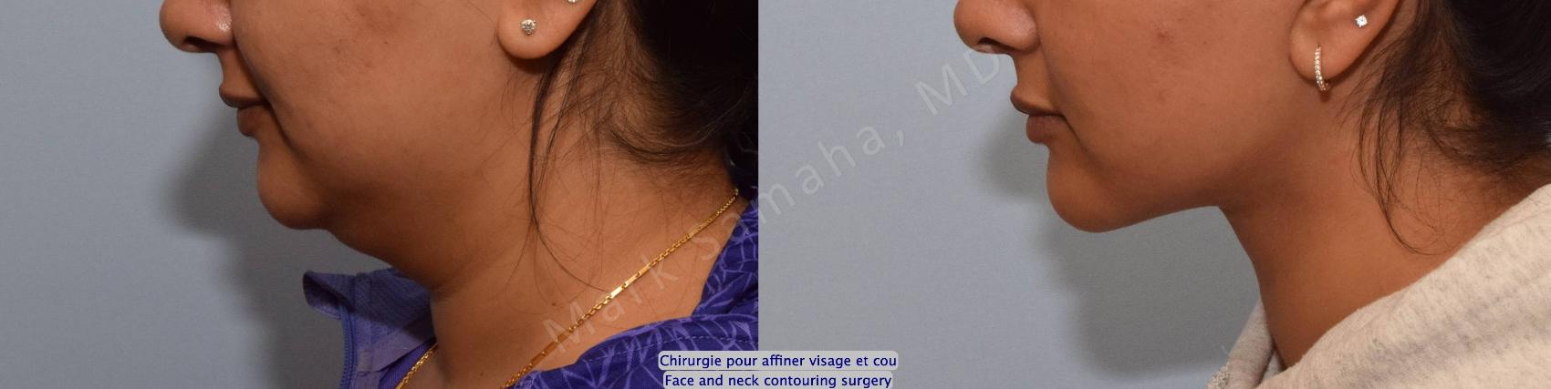 Before & After Chirurgie d’affinement du visage / Face Slimming Surgery Case 204 Left Side View in Montreal, QC