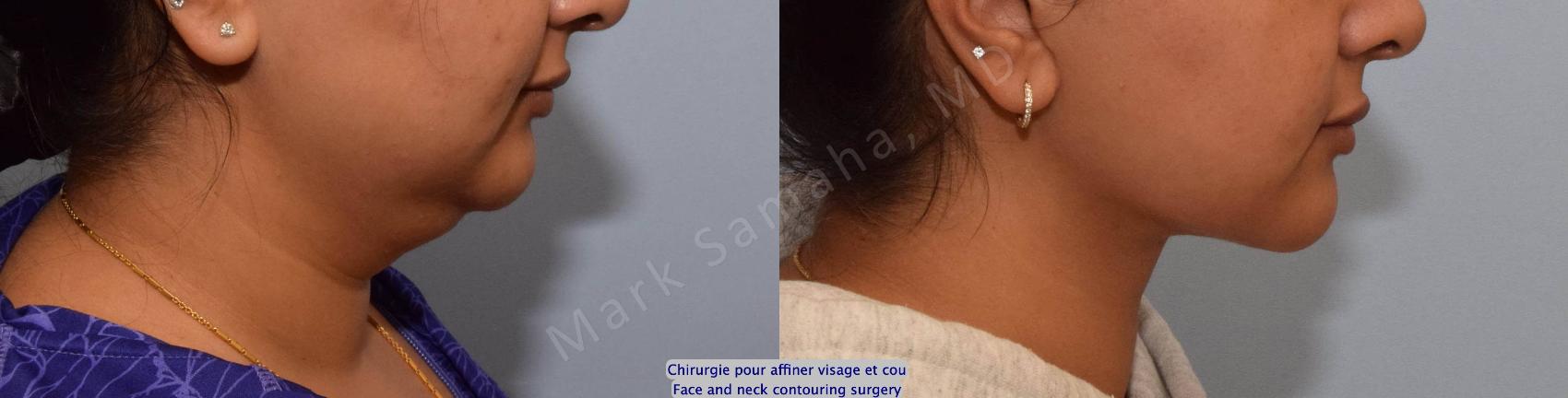 Before & After Chirurgie d’affinement du visage / Face Slimming Surgery Case 204 Right Side View in Montreal, QC