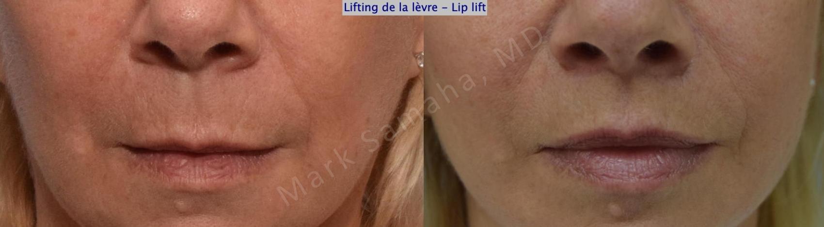 Before & After Lifting de la lèvre supérieure / Lip Lift Case 169 Front View in Montreal, QC