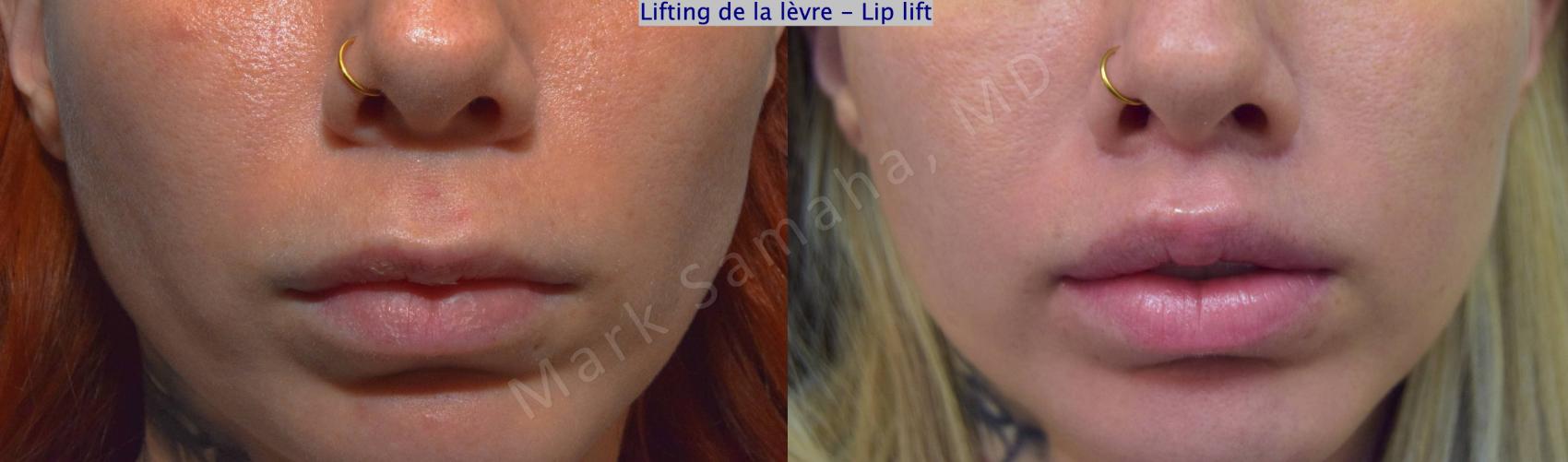 Transformative Advances in Lip Lift Cosmetic Procedures