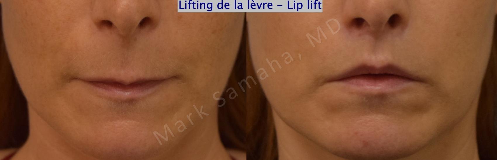 Before & After Lifting de la lèvre supérieure / Lip Lift Case 197 Front View in Montreal, QC
