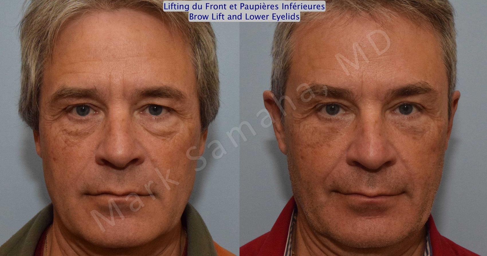 Before & After Blépharoplastie / Blepharoplasty Case 117 View #1 Detail View in Montreal, QC