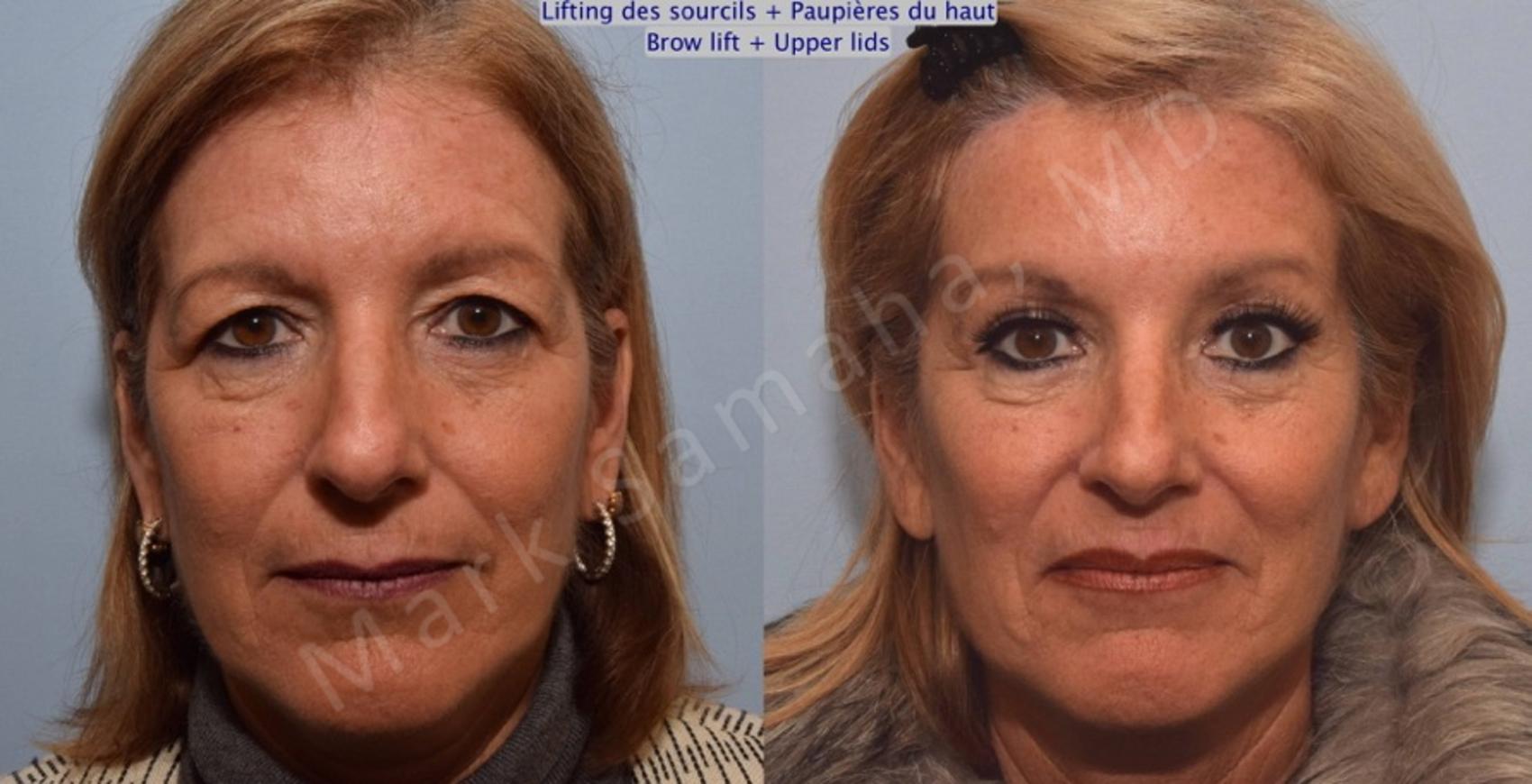 Before & After Blépharoplastie / Blepharoplasty Case 90 View #1 Detail View in Montreal, QC