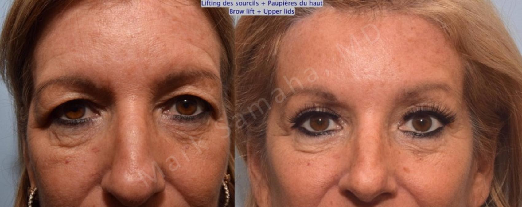 Before & After Blépharoplastie / Blepharoplasty Case 90 View #2 Detail View in Montreal, QC