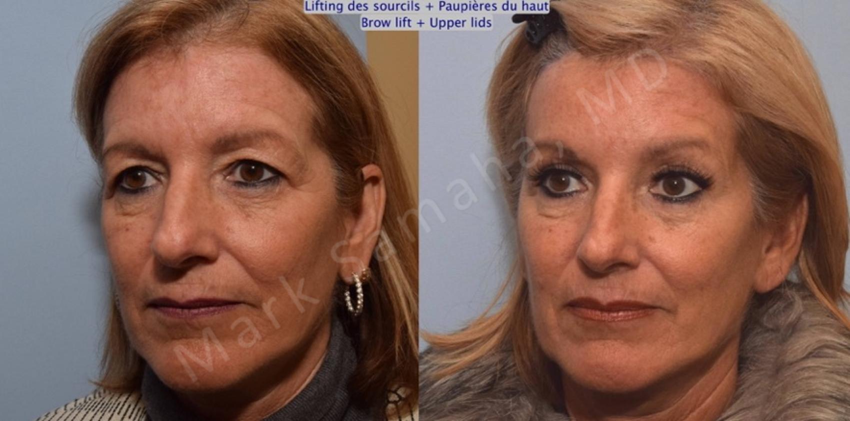 Before & After Blépharoplastie / Blepharoplasty Case 90 View #3 #Detail2 View in Montreal, QC